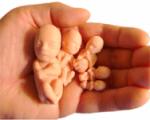 Медикаментозный способ прерывания беременности: рекомендации и ограничения