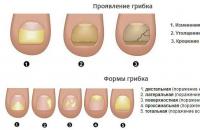 Волнистые ногти: причины, лечение